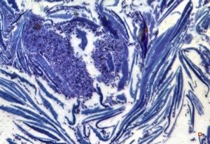 M,68y. | auditory meatus … otitis externa mycotica - (toluidine-blue- stained semithin section) M,68y. | auditory meatus … otitis externa mycotica - (toluidine-blue- stained semithin section)